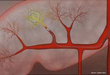 3 bệnh viện đầu ngành ứng dụng thành công điều trị ung thư gan bằng hạt vi cầu phóng xạ Spheres Yttrium 90