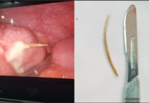 Phẫu thuật cấp cứu nội soi bệnh nhân bị “xương cá đâm thủng ruột”.