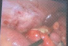 Phẫu thuật nội soi viêm ruột thừa ở vị trí bất thường dưới gan