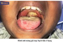 Những điều cần biết về bệnh Bạch Hầu