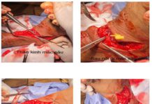 VẾT THƯƠNG PHỨC TẠP VÙNG CẲNG CHÂN